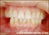CASE2　下顎の奥歯が無い方治療前
