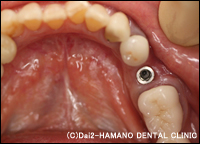 CASE3　下顎の奥歯を1本失った方治療前