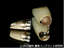 抜歯した当日にインプラントを入れる技術!