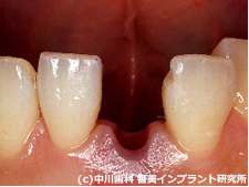 CASE1 歯が割れてしまった治療前