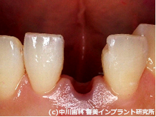 CASE1　歯が割れてしまった治療前