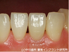 CASE1 歯が割れてしまった治療後