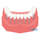 従来のインプラント治療の場合