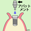 インプラントを埋め入れる