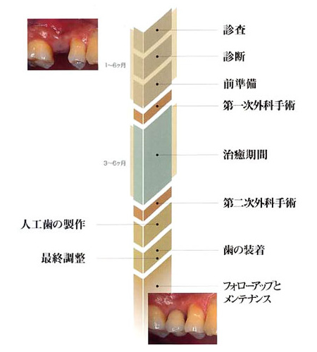 2回法インプラント