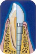 インプラント[人工歯根]システム