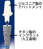 インプラント治療では金属を使うの?