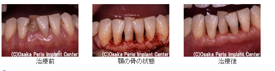 多くの歯が歯周病に侵された場合の治療