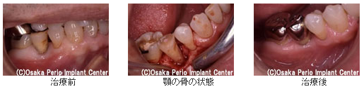 1本の歯が歯周病に侵された場合の治療