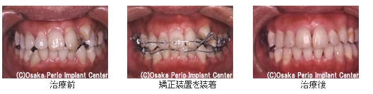 歯並びで歯周病に侵された場合の治療