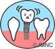 インプラントと虫歯