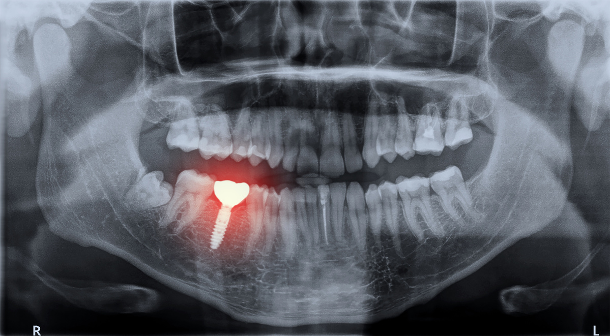 虫歯とインプラントどっちが先？虫歯の場所や症状で変わる治療の順番