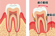 歯周病！骨が足りない！それでも受けたいインプラント