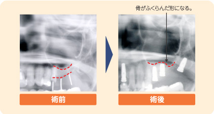 ソケットリフトの症例