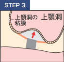 STEP3　粘膜を押し上げる