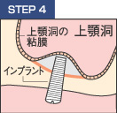 STEP5 インプラントを埋め入れる