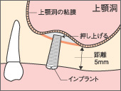 上顎の骨がない奥歯部分に最適な方法