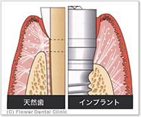 インプラントを長持ちさせるために知っておきたいこと