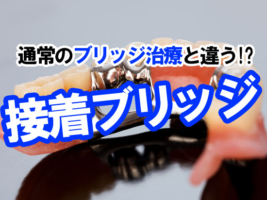 通常のブリッジ治療と違う「接着ブリッジ」をご紹介します。