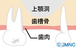 インプラント治療は可能？虫歯で歯を抜歯した時の治療ガイド ― 虫歯で歯を失った場合 