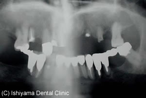 治療前の歯列全体のレントゲン写真