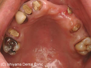 上顎前歯の欠損状態