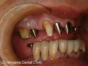 天然歯に対するアバットメントの右側方面観
