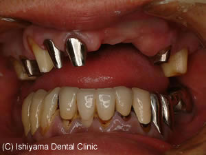 天然歯に対するアバットメントの前方面観
