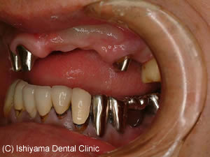 天然歯に対するアバットメントの左側方面観