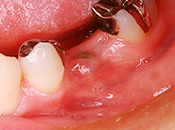 左下の中間歯を先天的に欠損している場合治療前