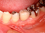 左下の中間歯を先天的に欠損している場合治療後