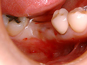 奥歯2本欠損したが、埋入スペースが狭い場合治療前