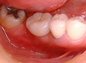 奥歯2本欠損したが、埋入スペースが狭い場合治療後