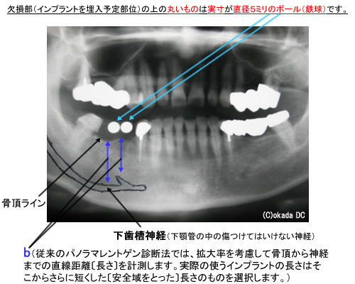 インプラント2本埋入の患者さんのパノラマレントゲン