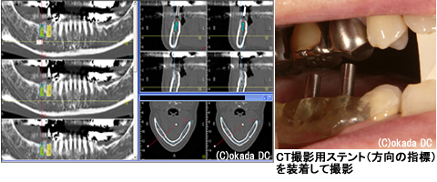インプラント2本埋入手術のＣＴ画像上でのシミュレーション