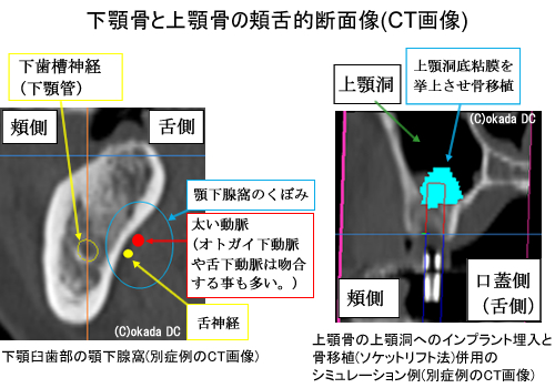 下顎骨と上顎骨の頬舌的断面像（CT画像）