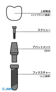 インプラント治療費の内訳