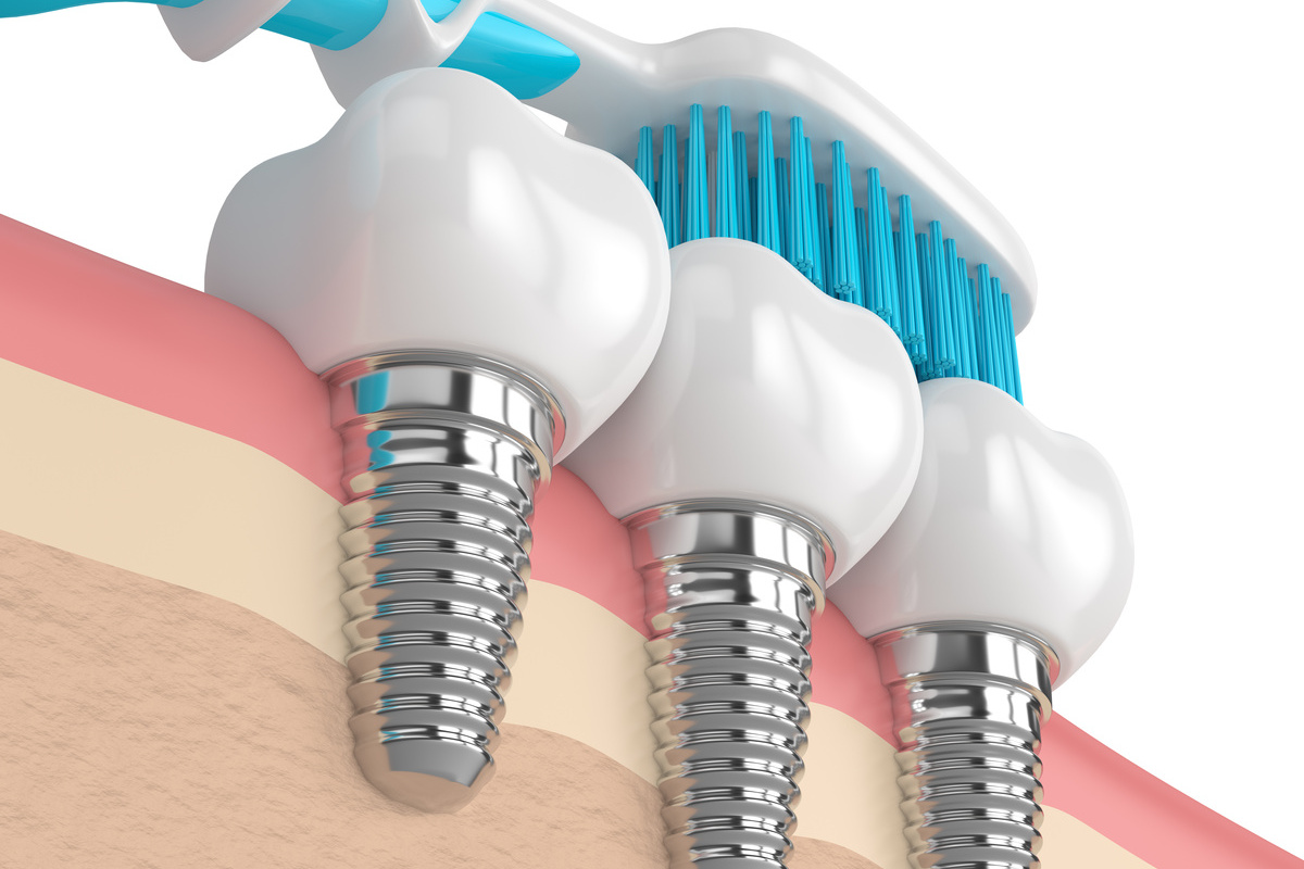 インプラントを長持ちさせるデンタルグッズの選び方ガイド