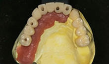STEP4 仮歯を作製