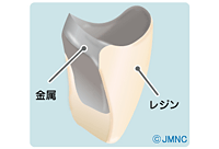 硬質レジン前装冠