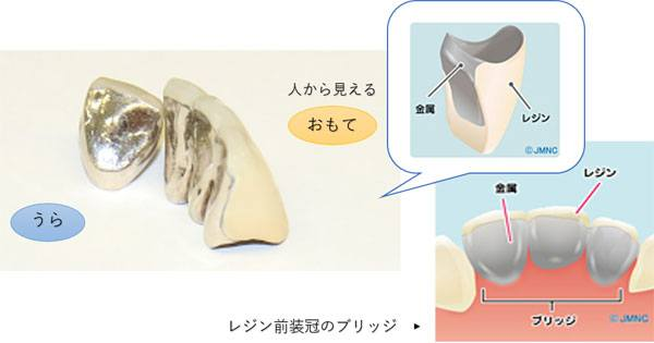 前歯（左右前から1~4番目の歯）の被せ物・差し歯