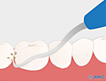 スケーラーによる歯石除去