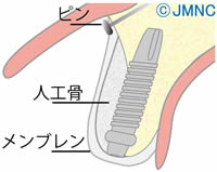 前歯を治療する方へ