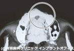 骨移植の場合(治療後)