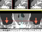 サイナスリフトの場合(治療前)