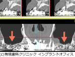 サイナスリフトの場合（治療前）