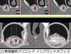 サイナスリフトの場合(治療後)