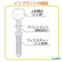  歯科用のインプラントの種類に違いはある?二回法用と一回法用ってなに?