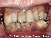 治療前の写真（口腔内写真）