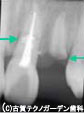 折れた2本の歯をインプラントで治療